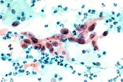 cervical-cancer-pap-smear-test.jpg